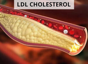 Làm gì để giảm mỡ máu cholesterol?