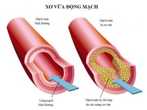 Phòng xơ vữa động mạch