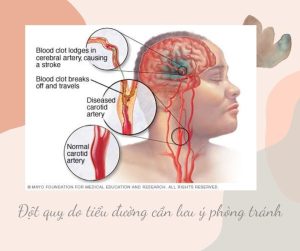 đột quỵ do tiểu đường