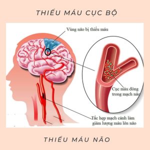 Thiếu máu cục bộ thoáng qua