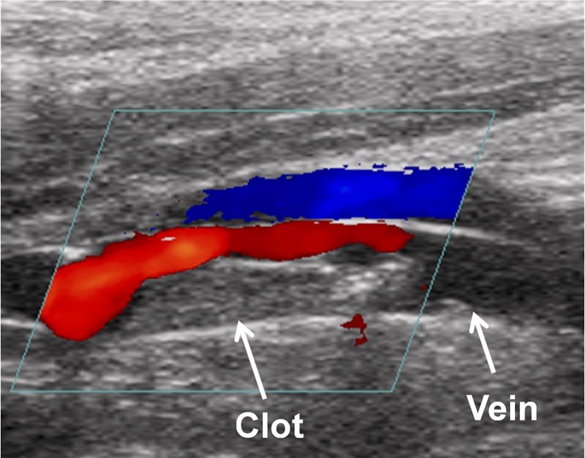 Chụp CT mạch máu để phát hiện huyết khối tĩnh mạch sâu