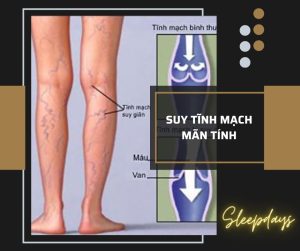 giãn tĩnh mạch khi mang thai