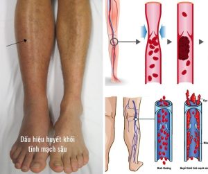 Dấu hiệu huyết khối tĩnh mạch sâu