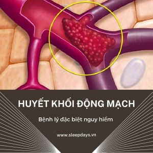 Huyết khối động mạch