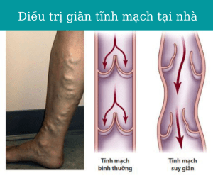 Điều trị giãn tĩnh mạch tại nhà hiệu quả