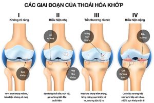 Bệnh viêm khớp dạng thấp, thoái hóa khớp