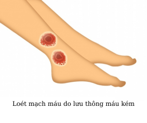 Loét mạch máu do lưu thông máu kém