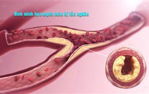 Các dấu hiệu tắc nghẽn mạch máu