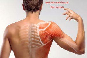 Đau vai phải và 13 nguyên nhân phổ biến