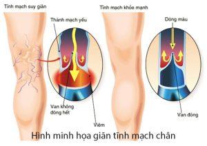 Giãn tĩnh mạch chân và những điều cần quan tâm