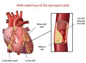 Hình minh họa về xơ vữa mạch vành