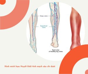 Huyết khối tĩnh mạch sâu chi dưới