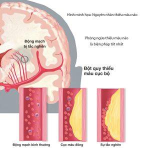 Nguyên nhân thiếu máu não và biện pháp phòng ngừa