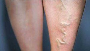 Thuốc trị giãn tĩnh mạch ở chân