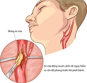 Xơ vữa động mạch cảnh có nguy hiểm không?