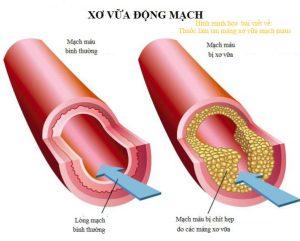 Thuốc làm tan mảng xơ vữa mạch máu 2023
