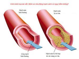 Bệnh xơ vữa động mạch vành có nguy hiểm không?