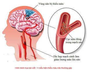 Biểu hiện thiếu máu não thường gặp