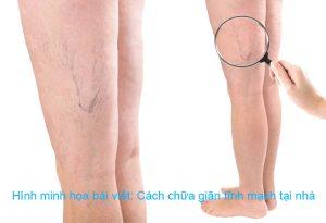 Cách chữa giãn tĩnh mạch tại nhà hiệu quả