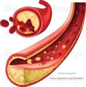 Máu lưu thông kém có nguy hiểm không?