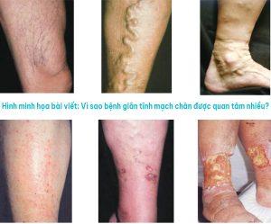 Vì sao bệnh giãn tĩnh mạch chân được quan tâm nhiều?
