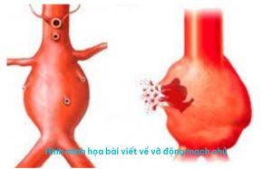 Vỡ động mạch chủ
