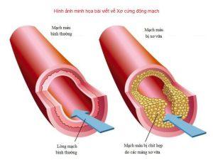Xơ cứng động mạch là gì? Nó có nguy hiểm không?