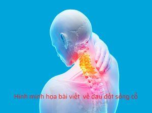 Đau đốt sống cổ do xơ vữa mạch máu gây ra